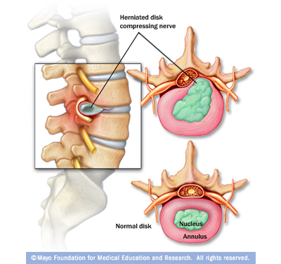Κήλη Μεσοσπονδύλιου Δίσκου